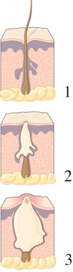 illustration of the three stages of a pimple